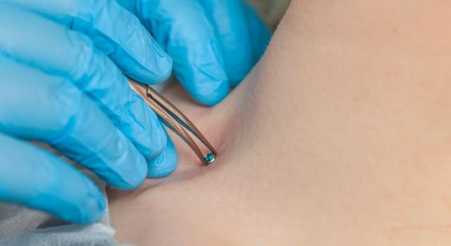 Come togliere dolore Microdermal piercing