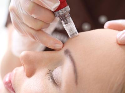 skin needling