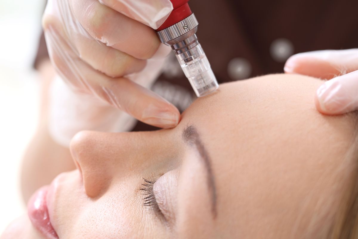 skin needling