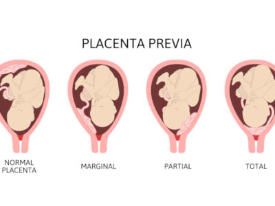 Posizioni placenta previa a confronto con placenta normale